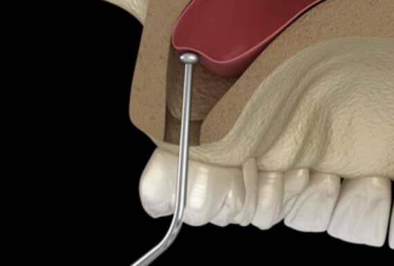 Rialzo del seno mascellare con tecniche minimamente invasive
